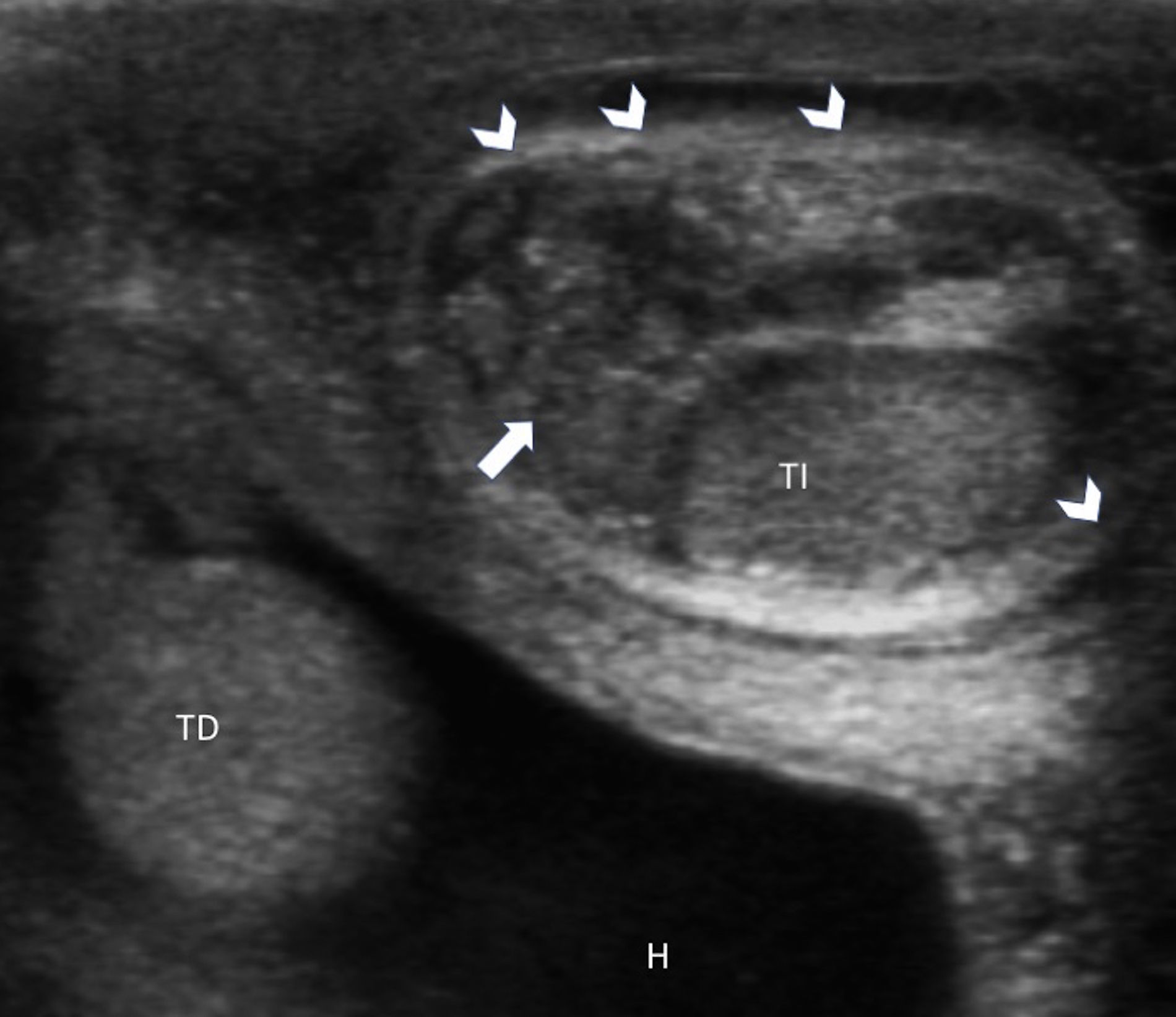 Perinatal testicular torsion: Ultrasound assessment and differential ...