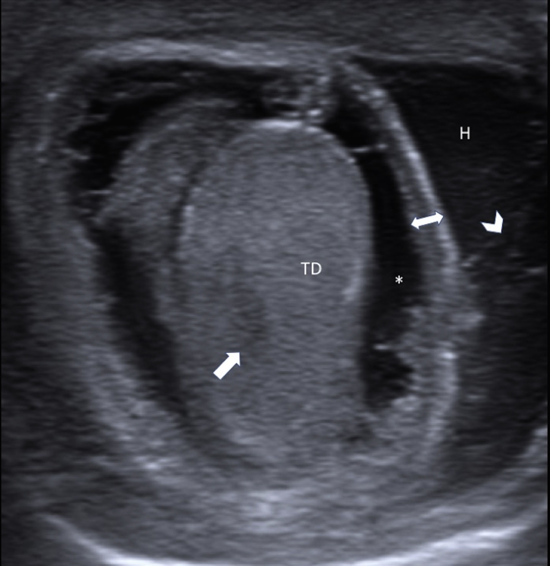 Infant Testes Perinatal testicular torsion: Ultrasound assessment and differential ...
