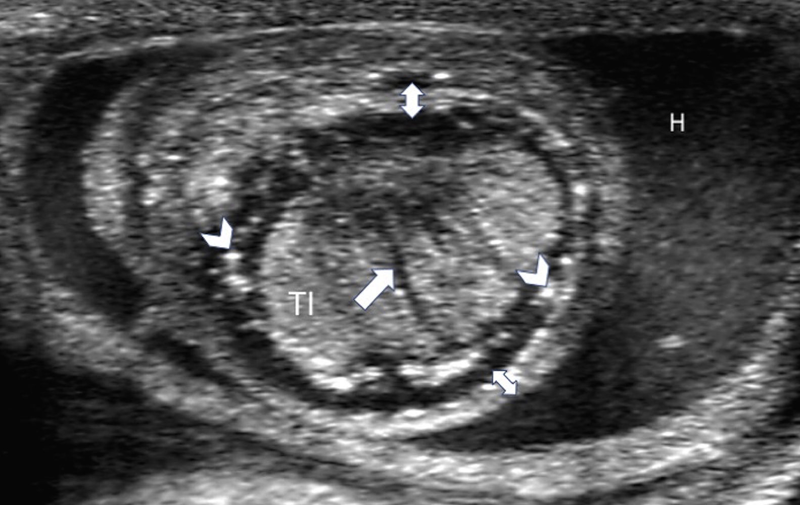Heterogeneous Testicle Perinatal testicular torsion: Ultrasound assessment and differential ...