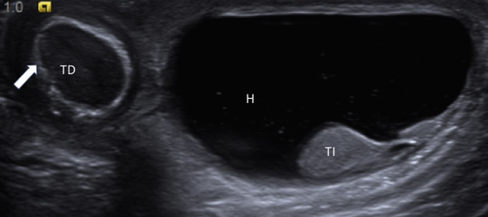 Infant Testes Perinatal testicular torsion: Ultrasound assessment and differential ...