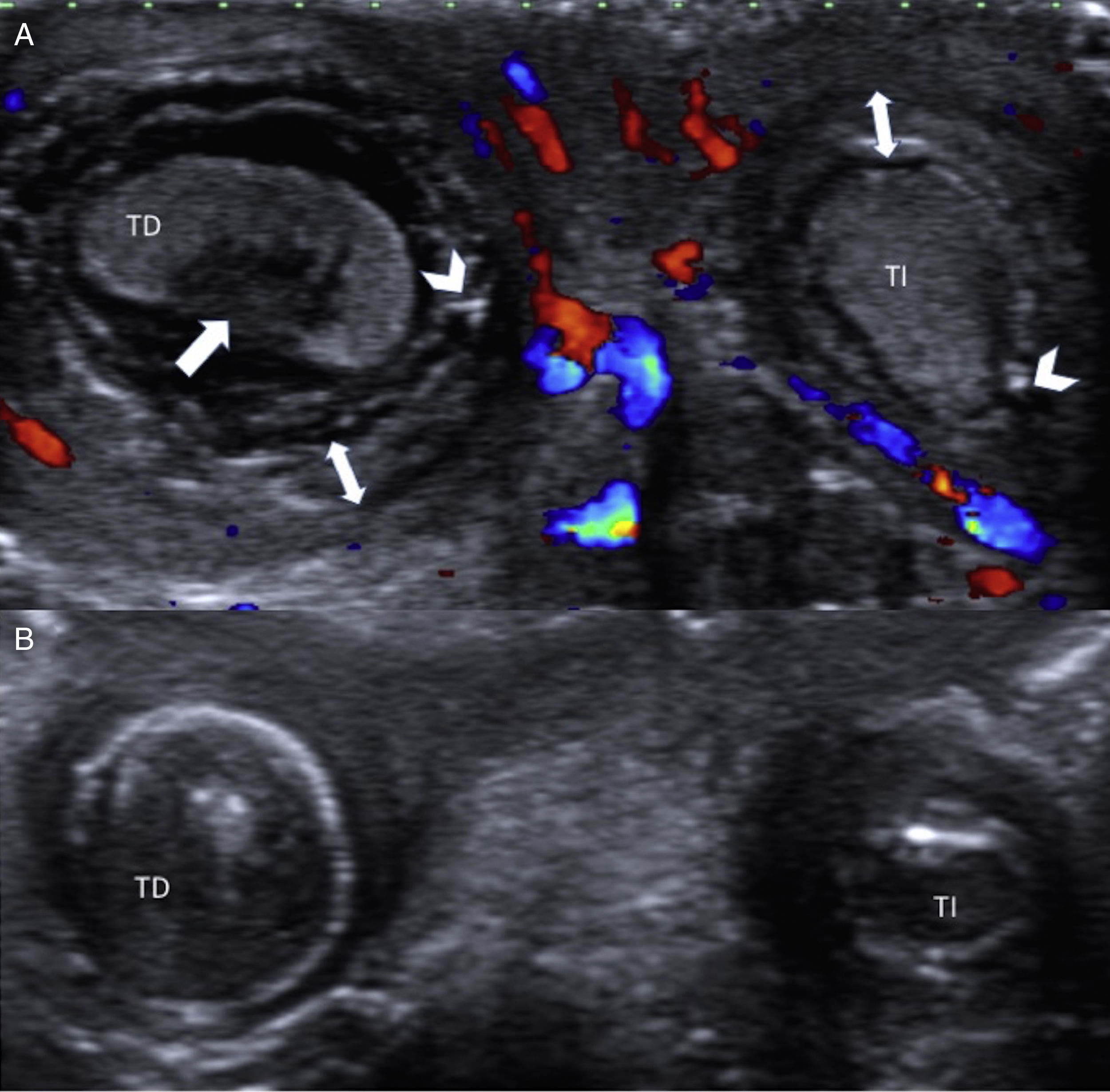 Infant Testes Perinatal testicular torsion: Ultrasound assessment and differential ...