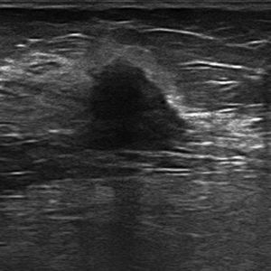 Luminal A type of breast cancer. The ultrasound shows one hypoechogenic solid lesion of angular edges, with an abrupt interphase, little posterior acoustic shadowing and non-parallel orientation to the skin.