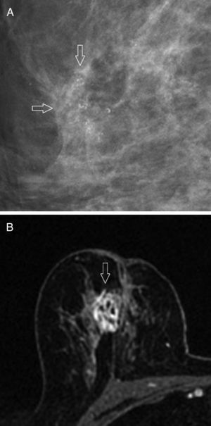 HER2 positive type of breast cancer. (A) Mammography: group of pleomorphic microcalcifications (arrows) that associate one irregular mass of poorly established edges. (B) MRI with contrast: the lesion shows heterogeneous internal enhancement (arrow).
