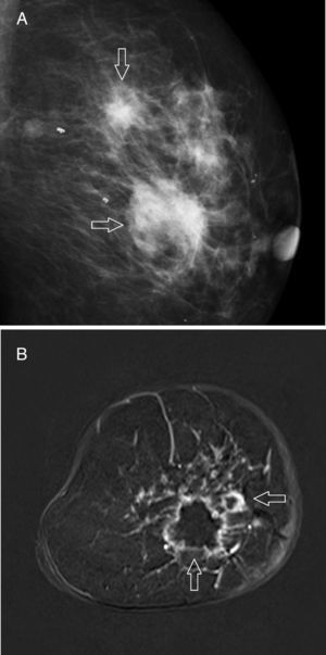 Triple negative type of breast cancer. (A) Mammography: two (2) irregular masses can be seen, with poorly established edges, and without microcalcifications (arrows). (B) MRI with contrast: both lesions (arrows) exhibit ring enhancement pattern.