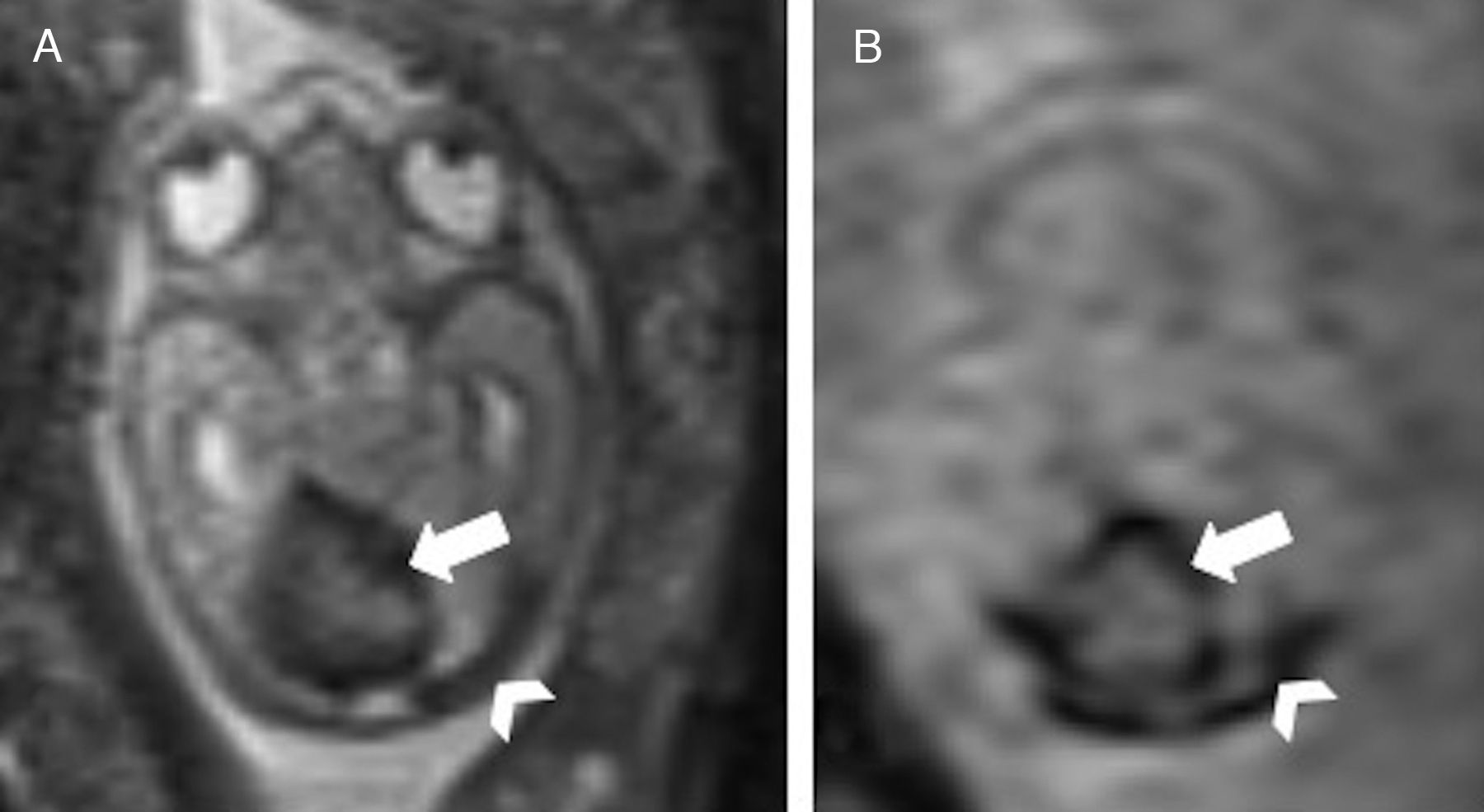 Evaluation of the fetal cerebellum by magnetic resonance imaging ...