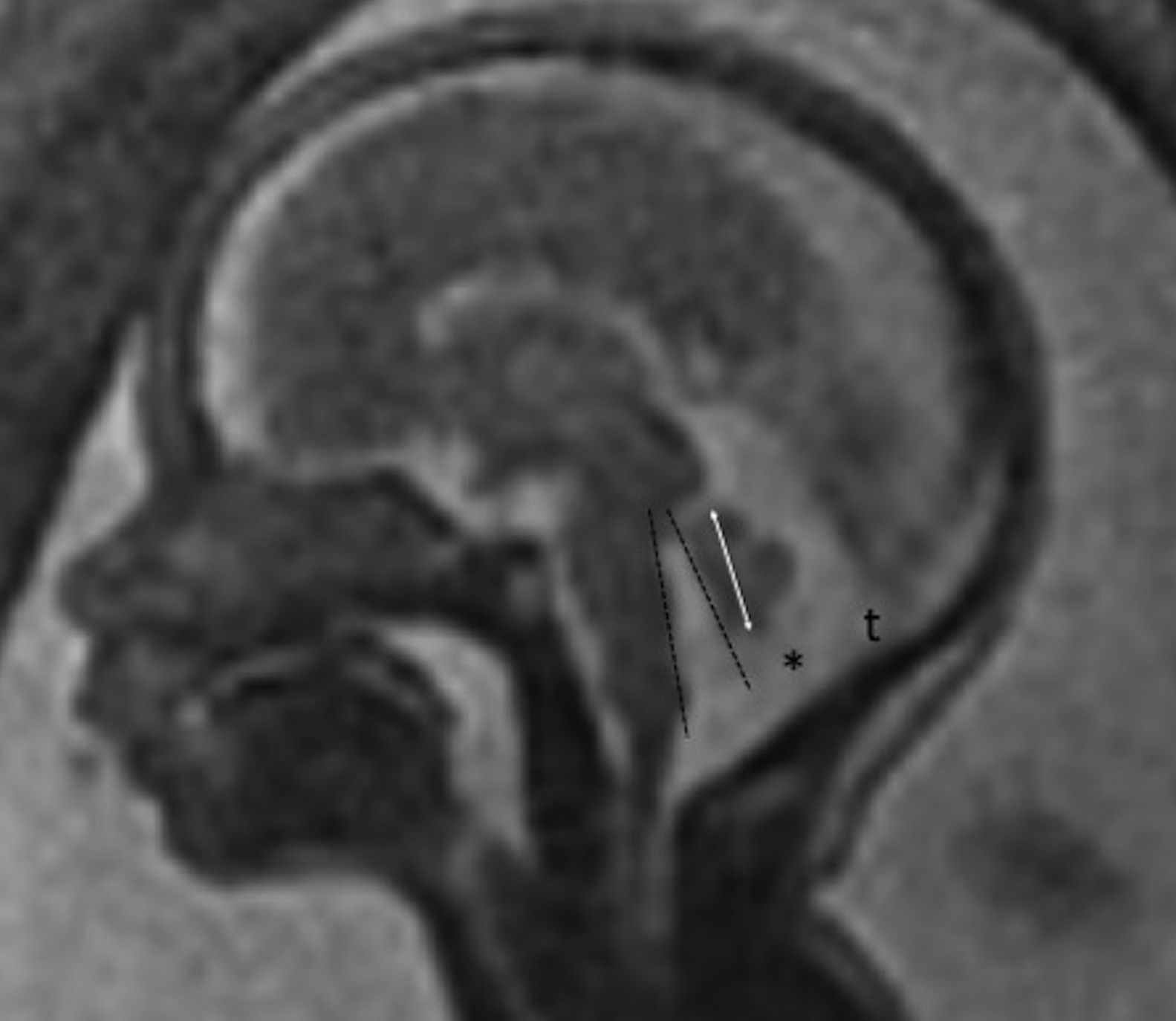 Evaluation of the fetal cerebellum by magnetic resonance imaging ...