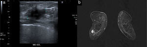 (a) Ultrasound scan showing one (1) hypoechogenic nodule of poorly established edges close to the patient's right breast external quadrant juncture. (b) Breast MRI: coronal image showing mass enhancement (15mm) consistent with the nodule described by the ultrasounds scan.