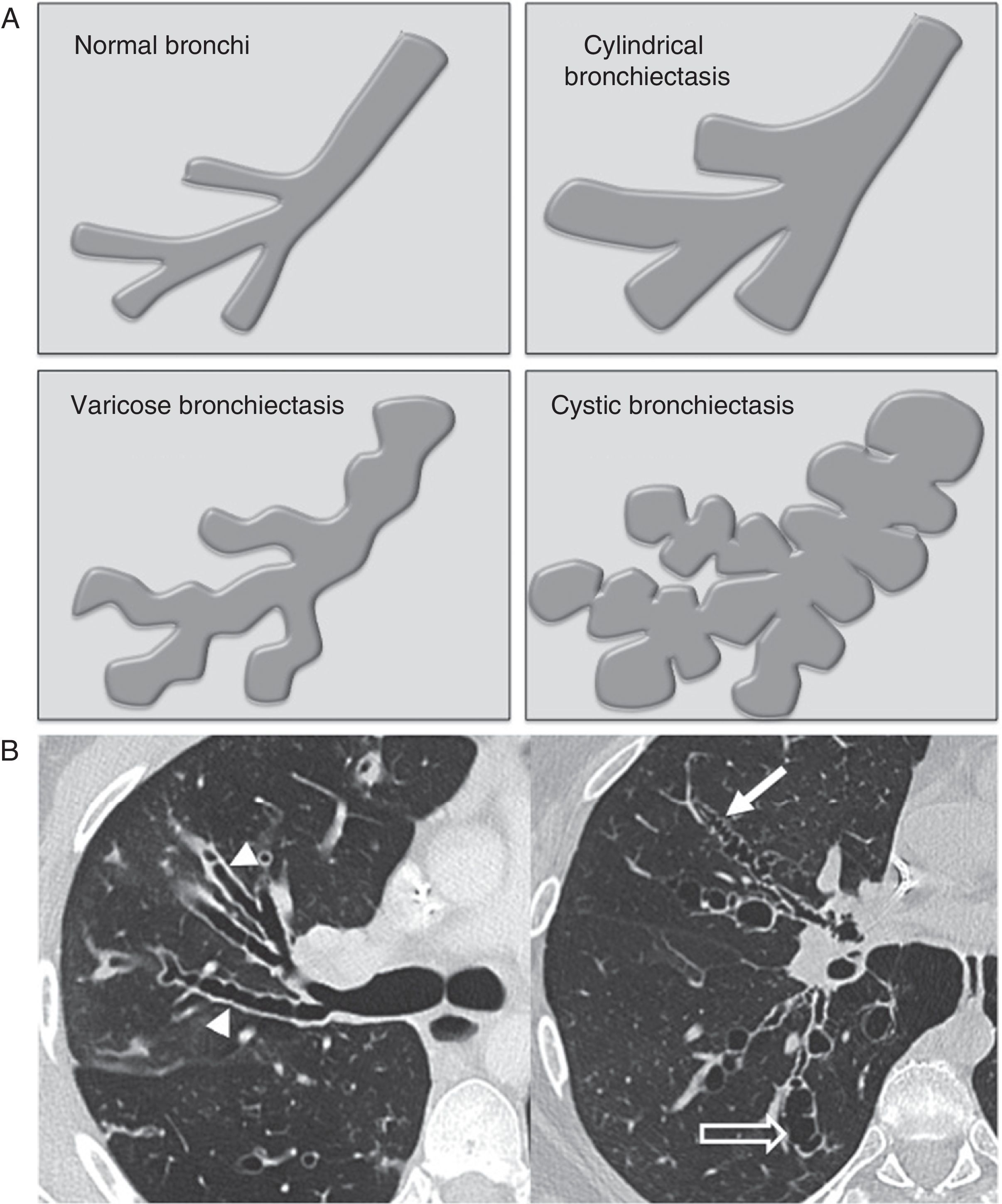 The role of imaging in the diagnosis of bronchiectasis: The key is in ...