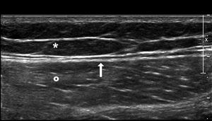 Normal superficial anatomy of the outer side of the thigh. Subcutaneous fat tissue (asterisk), deep fascia (arrow), and vastus lateralis muscle (circle). In the MLL, one trauma—usually a high-energy trauma, causes tangential shear that gives rise to a sudden separation of the skin and the subcutaneous cell tissue of the underlying fascia creating a cavity that ends up filling up with blood and lymph. MLL: Morel-Lavallée lesion.