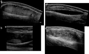 Progressive stages of the MLL on the ultrasound. At all time, these lesions behave like fusiform lesions of well-established edges. (a) Acute MLL. Acute lesions are usually heterogeneously hypoechoic. (b) On a second time, echogenic nodules representative of fat elements can be detected. (c) Subacute MLL. One-three months after the trauma, the MLL looks like one homogeneously, anechoic, fusiform collection of cystic appearance. (d) Chronic MLL. In the long run (several months or years), the lesion content is usually more complex. They usually behave like lesions of fusiform or lenticular morphology of heterogeneous content and mixed echogenicity. MLL: Morel-Lavallée lesion.