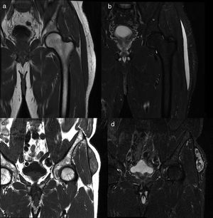 MRI findings on the MLL. Subacute MLL (a,b). Thirty-three-year-old patient weeks after falling from the bicycle. Images on the coronal plane focused on the left trochanteric region of T1-weighted sequences (a) and T2-weighted sequences with fat suppression (b) on the coronal plane. Most subacute MLLs, as it is the case here, have cystic appearance. Chronic MLL (c,d). Seventy-four-year old patient without known prior trauma. Images on the coronal plane focused on the trochanteric region. Lesion of mixed and heterogeneous signal intensity on T1-weighted sequences (c) and T2-weighted sequences with fat suppression (d). MLL: Morel-Lavallée lesion.
