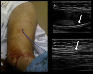 Patient with ultrasound-guided percutaneous drainage of one MLL located on the proximal and lateral segment of the thigh. (a) External appearance of the drainage catheter. (b) Catheter (arrow) inside the collection. (c) After the drainage, we can see almost the entire resolution of the collection, and the catheter (arrow) inside the minimal residual collection. MLL: Morel-Lavallée lesion.