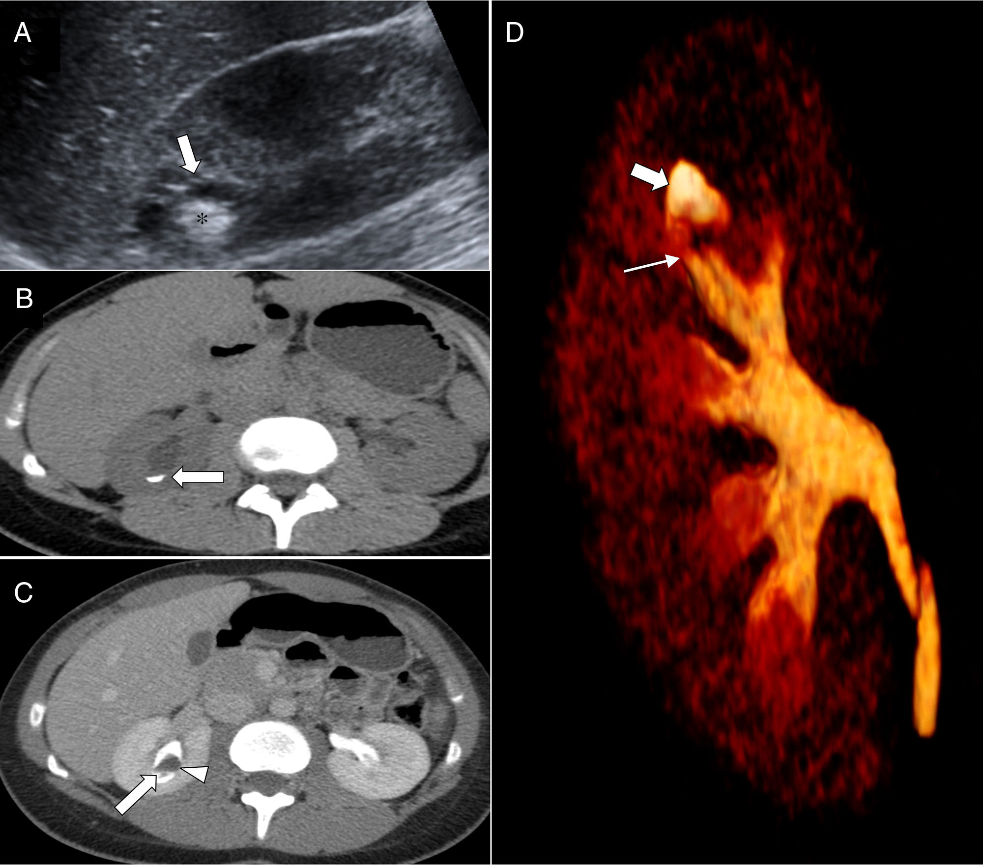 Calyceal diverticula in children: Imaging findings and presentations |  Radiología (English Edition)