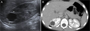 Eighteen-month-old baby girl with histiocytosis. Asymptomatic, study conducted according to protocol due to her underlying disease (A) abdominal B mode ultrasonography showing one well-established, polylobulated, anechoic lesion in the upper pole of the right kidney, suggestive of calyceal diverticulum (arrowheads). (B) Abdominal CT scan in the excretory phase at 5min, confirming level of contrast (arrowhead) inside the diverticulum (arrow).