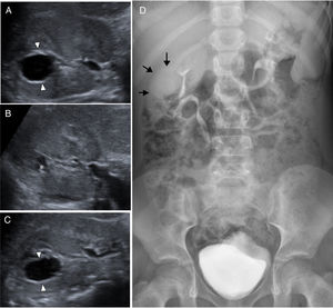 Seven-year-old boy without a prior history of recurrent abdominal pain. (A) Transversal view of the abdominal B mode ultrasonography of the right kidney showing one anechoic interpolar lesion that is interpreted as a simple renal cyst (arrowheads). (B) Control ultrasound at one year showing a significant reduction in the size of the cystic lesion with irregular morphology. (C) At the two-year control, the cystic lesion has increased in size. The change of size suggests communication with the excretory pathway. (D) Simple abdominal X-ray after CT scan with contrast confirming the presence of contrast material (arrows) filling up the cystic cavity in relation to the calyceal diverticulum.