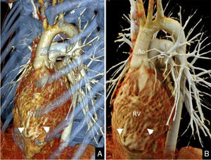 Thoracic angio-CT scan in an 18-year-old male diagnosed of congenital heart disease of the kind of congenitally corrected transposition of the great arteries due to ventricular inversion. (A) Volume rendering. (B) Cinematic rendering. Note the patient's mismatch between the arterial and ventricular systems: the aorta originates (Ao) from the morphologically right ventricle (RV) that shows hypertrophy of the moderator band (arrowheads).