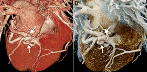 Coronary computed tomography angiography (CCTA) in a 72-year-old female with hypercholesterolemia and possible obstructive sleep apnea syndrome. She has remained asymptomatic from the cardiovascular point of view; however, 7 years ago she started experiencing dyspnea that she now experiences while trying medium-level efforts and consequently limits her daily activities. Occasionally, she would have suprasternal rhythmic and fast palpitations. One CCTA was requested in order to rule out coronary disease. (A) Volume rendering. (B) Cinematic rendering. The study showed one circumflex artery of a larger caliber and a winding trajectory that was more obvious in its distal third. There was direct communication between such artery and the great cardiac vein before entering the coronary sinus (arrows). Since this finding was not considered responsible for the patient's symptoms, it was agreed to keep monitoring the patient.