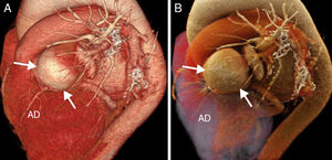 Coronary computed tomography angiography (CCTA) in a 67-year-old female in permanent atrial fibrillation and with a history of mitral aortic valve replacement. The echocardiographic examination showed an image suggestive of subvalvular pannus in the aortic valve with high velocity that was indicative of severe aortic stenosis. One CCTA was requested in order to assess the state of the patient's coronary arteries before proceeding with the intervention. (A) Volume rendering. (B) Cinematic rendering. The CCTA showed one aneurysm in the ostium and trunk of the left coronary artery of 45×47mm in diameter (arrows), and one anterior descending (AD) coronary artery of normal characteristics and without stenosis. The patient was operated through aortic valve replacement with valved graft, saphenous vein graft to the anterior descending coronary artery, and anastomosis of the right coronary to the valved graft. The circumflex artery could not be found during the intervention. The left coronary trunk was ligated at its origin for the closure of the aneurysmal sac. The patient's progression after the surgery was satisfactory.