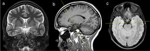Coronal T2-weighted sequence with short tau inversion recovery (a) acquired using, as a reference, sagittal images of T1-weighted sequences using the inversion recovery technique (b) and axial T2-weighted sequences using the inversion recovery technique in order to adjust the asymmetry of hippocampal structures (c).
