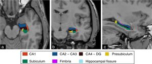 Axial (a), coronal (b), and sagittal (c) images showing the segmentation of hippocampal structures using the FreeSurfer tool.