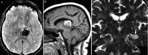 Examples of strategic infarcts. (A and B) Strategic hemorrhagic infarct in the left thalamus in A (axial gradient echo sequence) and B (saggital FLAIR T1 sequence). (C) Coronal FSE-T2 image showing one hyperintense, acute ischemic lesion on the left hippocampus.