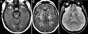 Thirty-eight (38) year old female with a diagnosis of CADASIL. (A) Axial T2 FLAIR image. Hyperintense lesions of subcortical white matter in typical temporal location. (B) Axial T2 FLAIR images. Multiple hyperintense lesions of diffuse distribution with a tendency toward confluence, in pathological grade, at any age. (C) Axiales slices on the gradient echo sequence showing multiple microhemorrhagic foci associated with basal ganglia.