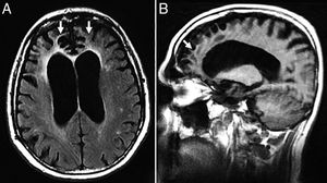 Seventy-two (72) year old male with frontotemporal dementia in its the behavioral variant. (A) Axial FLAIR T2 sequence. Slightly asymmetric bilateral frontal atrophy of right predominance with underlying gliosis. (B) Saggital FLAIR T1 image showing the anteroposterior gradient of atrophy.