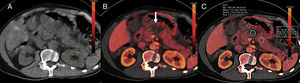 55-year-old male with acute pancreatitis. Computed tomography (CT) scan without contrast (A), color-coded iodine concentration map (B) and map with region of interest (ROI) measuring the concentration of iodine (C). The dual-energy computed tomography shows an area of necrosis at the level of the pancreatic body shown in the color-coded iodine concentration map as an area without iodinated contrast uptake (arrow) being the iodine quantified by placing one ROI in the gland parenchyma.