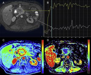 Pancreatic magnetic resonance perfusion imaging study of a patient with head gland pancreatic adenocarcinoma. The dynamic MRI study with contrast (A) conducted shows one large mass with poorly-established edges and extensive areas of central necrosis (white straight solid arrow). The uptake curves (B) show clear differences in the central portion with little enhancement (white curve and dotted arrow) while the more feasible periphery shows type II curve pattern (yellow curve and dotted arrow) with fast enhancement and plateau after the enhancement peak. Also, perfusion allows us to evaluate tissues based on semiquantitative parameters that analyze the characteristics of the enhancement curves such as the area under the curve (AUC) (image C) or quantitative parameters such as the efflux rate constant (Kep) (image D) based on mathematical models that are more difficult to obtain but also much more biologically significant.