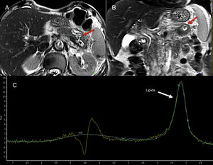 74-year-old-male admitted to the hospital with abdominal pain. The T2-weighted tubo spin-echo sequences on the axial (A) and coronal (B) planes used as a reference to locate the lesion show one 4cm-cystic mass located in the pancreatic body-tail that looks markedly hyperintense on T2 (red arrows). The spectroscopy with a short echo time (ET) of 35ms (C) shows fat peak levels at 1.3ppm possibly suggestive of necrosis. The surgery confirmed the presence of one cavitated lesion with necrohemorrhagic content and epithelial coverage consistent with one mucinous tumor.