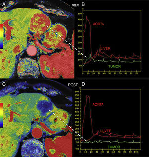 Hepatic metastasis of pancreatic neuroendocrine tumor treated with antiangiogenic therapy. Parametric maps of blood flow pre-treatment (A) and 15 days after angiogenic therapy (C) overlapping the anatomical image of a CT scan (50% transparency) and uptake curves of the metastatic lesion (in green), the aorta and the normal hepatic parenchyma (B and D) showing significant tumor response with a drop of metastatic flow from 118ml/100g/min to 8ml/100g/min and change in the morphology of the enhancement curve of the lesion from one enhancement curve with washout (type 3) (B) to one plane curve with almost no changes (D).