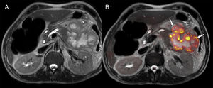 45-year-old patient with necrotizing acute pancreatitis and presence of encapsulated pancreatic and peripancreatic necrosis with signs of infection on the MRI. Axial T2-weighted image (A), diffusion weighted imaging (DWI) in T2 and diffusion imaging with high b values (b800) in the color-coded map (B). The fusion of the images shows the restriction of diffusion in the periphery of the collection suggestive of its overinfection (arrows).