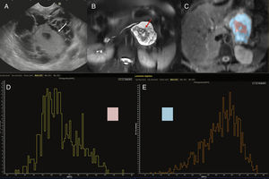 45-year-old female with cystic tumor in the pancreatic tail. Endoscopic ultrasonography (EUS) imaging (A), T2-weighted MRI with fat saturation (B), ADC map with color segmentation of peripheral (blow) and central (pink) portions (C) and histograms corresponding to the ADC values of such portions of the mass (D and E). Both the endoscopic image and the T2-weighted MRI with fat saturation show one cystic mass with a solid central component (white arrows in the EUS image and red arrows in the T2-weighted MRI). The analysis of the ADC map shows the peripheral cystic portion (segmented in blue) with high ADC values in the histogram (E) and an average ADC value of 2.7, while the solid central portion (segmented in pink) shows lower values on the ADC map (D) with an average ADC of 2.1. After the surgery, the anatomopathological diagnosis was mucinous cystadenocarcinoma.
