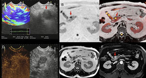 Multimodal image of one pancreatic neuroendocrine tumor. Images of an endoscopic ultrasound with elastography (A), diffusion imaging in b1000 with gray-scale inversion (B), fusion of the T2-weighted imaging and the diffusion imaging in b1000 in color (C), endoscopic study with ultrasound contrast (D), T2-weighted MRI (E) and T1-weighted MRI with contrast in the portal phase (F). The endoscopic ultrasound scan shows one lesion (red arrow in A) with a homogeneous blue elastographic pattern (common of malignant tumors) and enhancement after the administration of contrast (D). The MRI with diffusion (B) and the fusion imaging color map (T2+diffusion) (C) clearly show one small tumor in the pancreatic isthmus that looks more enhanced than the parenchyma after the administration of paramagnetic contrast (F) (red arrows).