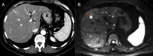 Staging of pancreatic tumors using DWI. Patient operated on one pancreatic neuroendocrine tumor with high levels of chromogranin A during follow-up. The image from the CT scan with contrast in the arterial phase and on the axial plane (A) shows one slightly hypervascular hepatic lesion (white arrow). At the same level of the CT scan, the DWI of the liver with a b800 value (B) confirms the existence of this lesion (red arrow) and shows countless hepatic subcentrimetical lesions with hypersignal in diffusion corresponding to hepatic metastases.