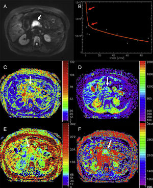 Analysis using monoexponential models of a patient with adenocarcinoma in the pancreatic head (arrows). DWI in b800 (A), curve of the drop of signal intensity with higher b values (B), parametric maps obtained using the intravoxel incoherent motion (IVIM) technique of perfusion fraction (C), perfusion-free diffusion (D), kurtosis parametric maps (E), and apparent diffusion (F). The DWI shows the neoplasm (white arrow in A). The tumor shows a marked quick drop of signal intensity in diffusion with higher b values in b values <100 (red arrows in B), suggestive of an important perfusion component and/or pseudo-diffusion in the gland structures of the mass with an average perfusion fraction value (f) of around 25% (C) and low values of perfusion-free diffusion (D*) (image D). The tumor shows higher kurtosis values (image E) (possibly due to the higher structural complexity of the tumor) and a reduced apparent diffusion or Dk (F) – one parameter used to correct the non-Gaussian behavior of diffusion at high b values.