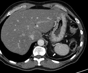 72-Year-old-male with intraductal papillary mucinous neoplasm who underwent one splenopancreatectomy procedure. Unresected accessory spleen that has tripled in sized compared to the presurgical study (not shown).