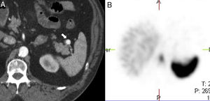 64-Year-old male with a positive fecal occult blood test. The CT scan with IV contrast in the arterial phase (A) shows one small hypervascular nodule anterior to the edge of the distal pancreatic tail. The lesion is hyperdense with respect to the spleen in the phase shown. The gammagraphy of denatured red blood cells marked with technetium-99m (B) shows the lack of isotope uptake by the nodule. It is consistent with an aneurysm of the splenic artery (note the similar attenuation of the aorta).