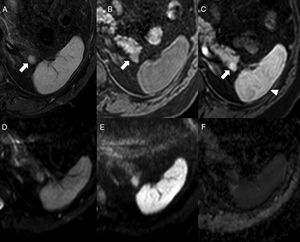 64-Year-old-male with ankylosing spondylitis. The abdominal MRI shows one isointense nodule to the spleen in STIR (A) in the T1-weighted THRIVE sequence prior to the administration of contrast (B) and in the post-contrast study in the arterial phase (C) (note the arciform pattern enhancement of the spleen, arrowhead). In the diffusion sequences (D: b0, E: b1000 and F: ADC map), the intensity of the nodule is parallel to that of the spleen. It is consistent with one intrapancreatic accessory spleen.