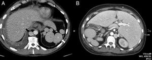 51-Year-old-male with one pulmonary mass. The CT scan with IV contrast (A) shows findings of heteotaxy syndrome: polysplenia in left hypochondrium (white arrow) and lack of intrahepatic segment of the inferior vena cava replaced by the azygos vein (black arrow). Thirty-seven-year-old female with subocclusive clinical manifestations (B) with heterotaxy syndrome and situs inversus with specular image in the location of the polysplenia and hypertrophied azygos vein compared to case A.