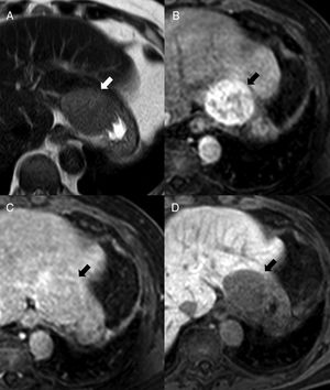 55-Year-old-male with hepatic cirrhosis and splenectomy. The ultrasound scan conducted to screen for hepatocellular carcinoma given the patient́ condition (images not shown) shows one 5cm-mass in his left hepatic lobe. On the MRI the lesion, medial to the stomach, is hyperintense in T2 (A), heterogeneous hipervascular in the arterial phase after the administration of IV gadolinium (B), discreetly hypointense on the phase-cycled balanced (C) and partially surrounded by a thin capsule. The lesion appears hypointense in the hepatocellular phase after the administration of gadoxetic acid (D). The preoperative diagnostic suspicion was hepatocellular carcinoma, but the resection confirmed it was one intrahepatic splenosis.