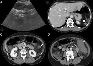 55-Year-old-female with intense abdominal pain and fever. The longitudinal ultrasound slice through the left flank (A) shows one solid, discreetly heterogeneous structure without color Doppler signal inside. These CT scans with axial contrast (B, C and D) show the torsion of a wandering spleen. There is lack of spleen in the left hypochondrium (asterisk in B); the splenic vessels (not filled with contrast) make up a “whirlwind” in the left flank (arrowhead in C) and the non-enhancing spleen moves caudally (arrowhead in D). The splenectomy confirmed the torsion of the vascular pedicle of one wandering spleen associated to a hemorrhagic infarction of the organ.