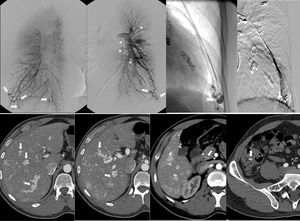 33-Year-old male with known diagnosis of Rendu–Osler–Weber syndrome. Pulmonary arteriogram (a–d) shows multiple bilateral arteriovenous malformations (AVMs) predominately involving the pulmonary bases (arrows) (a: right, b: left). Selective catheterization and arterial embolization of a left basilar AVM (arrow, c) with good results after treatment (arrowhead, d). Evidence of prior AVMs embolization also noted on b (arrowheads). Abdominal CT (e–h) reveals multiple AVMs seen throughout the hepatic parenchyma (arrows on e, f) with arterial portal shunting and associated hypertrophy of the celiac trunk and hepatic arteries (voided arrows on f). Multiple telangiectasias associated with enteric mucosa in the region of the pylorus, and ileocecal valve are also seen (arrows on g,h).