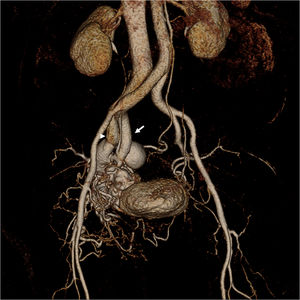 65-Year-old woman with AVM in the right side of the pelvis. Volume rendering reconstruction CE MRA shows that the AVM consists of branches from the hypertrophied right internal artery (arrow), a nidus and a large venous varix that drains into the right internal iliac vein (arrowhead).