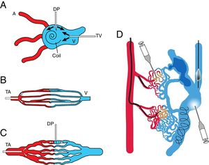 Schematic representation of the access route for treatment according to the angiographic type of arteriovenous malformations. Adapted from Cho SK, et al. J Endovasc Ther. 2006;13:527–538. (A) Transvenous approach and direct puncture of the nidus for type I and II, (B) transarterial approach for type IIIa, (C) transarterial approach and direct puncture for type IIIb. (D) Mixed lesions may require a combined approach. A: artery; V: vein; TV: transvenous, DP: direct puncture; TA: transarterial.