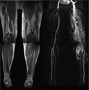 52-Year-old female with Parkes Weber syndrome. Cutaneous capillary malformations with marked left lower extremity hypertrophy were noticeable on clinical exam. T1-weighted MR image (a) reveals marked limb hypertrophy. Arterial phase Contrast-enhanced MRA (b) shows an enlarged femoral artery (arrow), numerous AVMs throughout the extremity (asterisk) and early venous shunting (arrowhead).