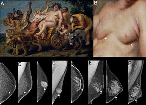 (A) The triumph of Bacchus. Oil on canvas by Cornelis de Vos (1636–1638), on display in the Prado Museum, Madrid, Spain. (B) Enlarged view of the model's torso, showing enlarged breasts (white arrows). (C) Left craniocaudal oblique mediolateral view showing that the breast volume is composed of adipose tissue. Mammographic diagnosis of lipomastia (white arrows). (D) Left craniocaudal oblique mediolateral view showing the nodular mammographic pattern, consistent with the breast volume being due to gynaecomastia (white arrows). (E) Left craniocaudal oblique mediolateral view showing the dendritic mammographic pattern, consistent with enlargement of the breast due to gynaecomastia (white arrows). (F) Left craniocaudal oblique mediolateral view showing the diffuse glandular mammographic pattern, consistent with enlargement of the breast due to gynaecomastia (white arrows).