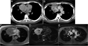 Computed tomography (CT) and magnetic resonance (MRI) images of the thorax in the axial plane, showing the mediastinal mass (black arrowheads). (A) On CT without contrast, the mass is seen to contain multiple phleboliths. (B) After administration of contrast, slight enhancement of the thoracic mass is observed with multiple vascular structures in its interior that converge in a large drainage vein (white arrow) that leads to the dilated superior vena cava (asterisk). (C–E) On MRI, the mediastinal mass is slightly hypointense in the T1-weighted sequence (C), markedly hyperintense in T2 Fat-Sat FRFSE (D), and slightly enhanced in the LAVA T1-weighted gradient-echo sequence after the administration of intravenous gadolinium (E).