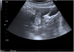 Oblique view of the right iliac fossa. Haemorrhagic follicular cyst (between markers) with associated hyperechogenic free fluid (arrow), consistent with haemoperitoneum due to cyst rupture.