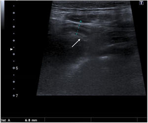 Ultrasound. Transversal view of the right iliac fossa. Segment of enlarged, but compressible, appendix (between markers). It was not possible to visualise the entire appendix, and it was also associated with hyperechogenic fat (arrow), so it was included in category 3 (inconclusive). Follow-up ultrasound at 24h showed an increase in diameter and the patient underwent surgery (final diagnosis of acute appendicitis).